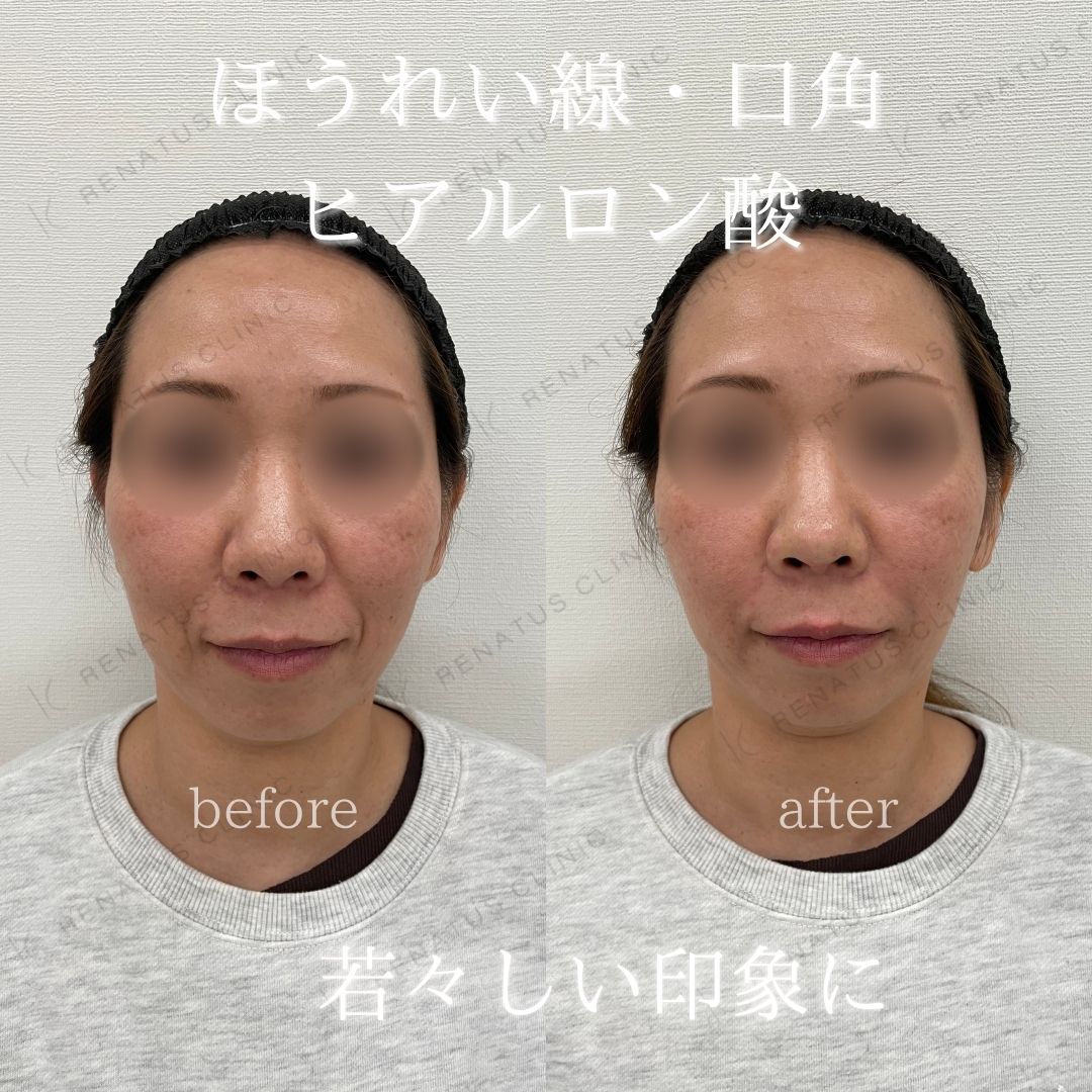 ヒアルロン酸仙台ほうれい線上手い ヒアルロン酸仙台ほうれい線上手い