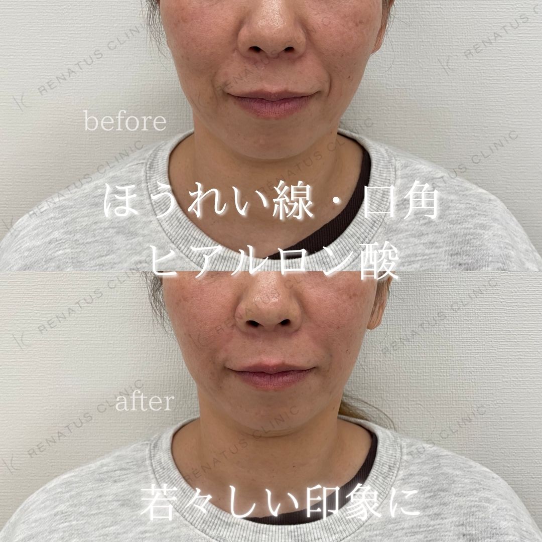 ヒアルロン酸仙台ほうれい線上手い ヒアルロン酸仙台ほうれい線上手い