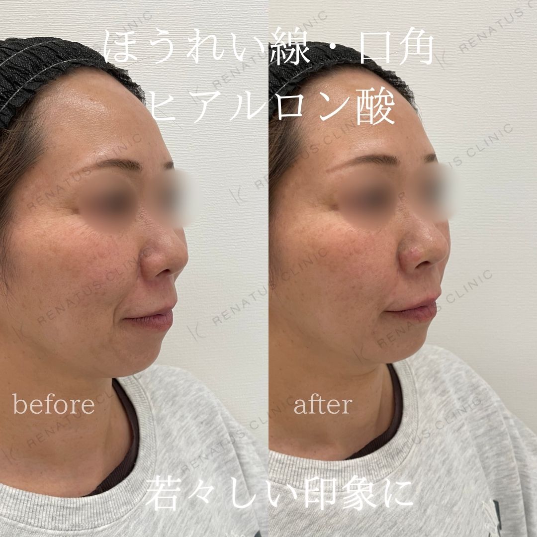 ヒアルロン酸仙台ほうれい線上手い ヒアルロン酸仙台ほうれい線上手い