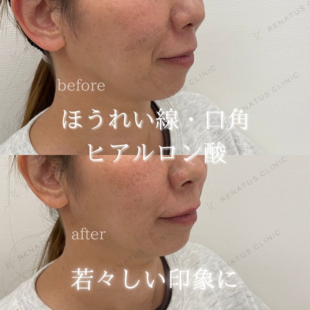 ヒアルロン酸仙台ほうれい線上手い ヒアルロン酸仙台ほうれい線上手い