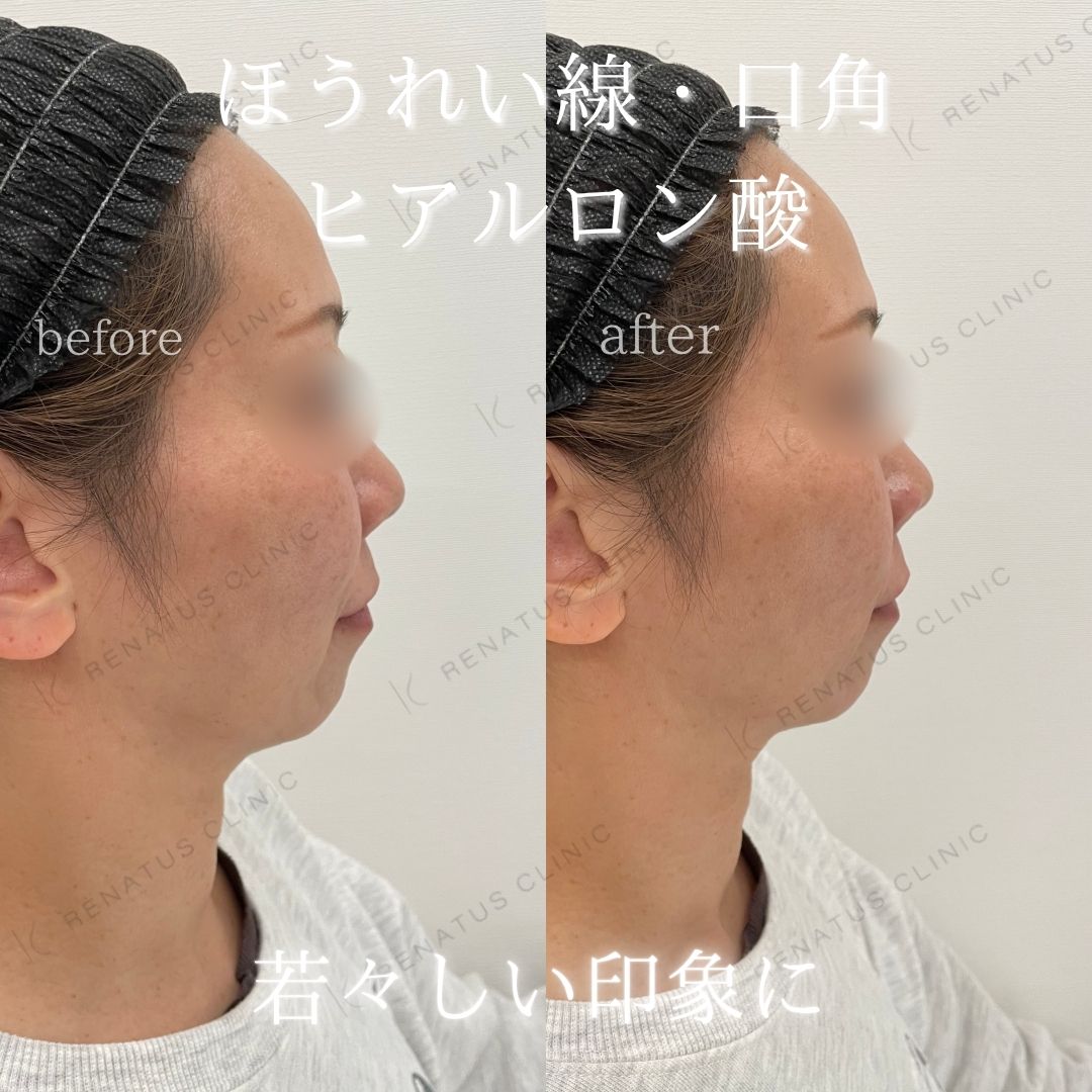 ヒアルロン酸仙台ほうれい線上手い ヒアルロン酸仙台ほうれい線上手い