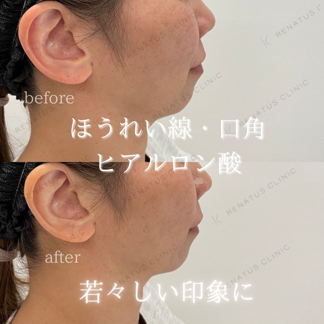 ヒアルロン酸仙台ほうれい線上手い ヒアルロン酸仙台ほうれい線上手い