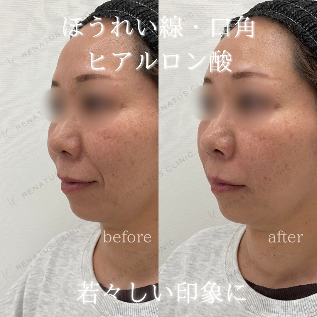 ヒアルロン酸仙台ほうれい線上手い ヒアルロン酸仙台ほうれい線上手い