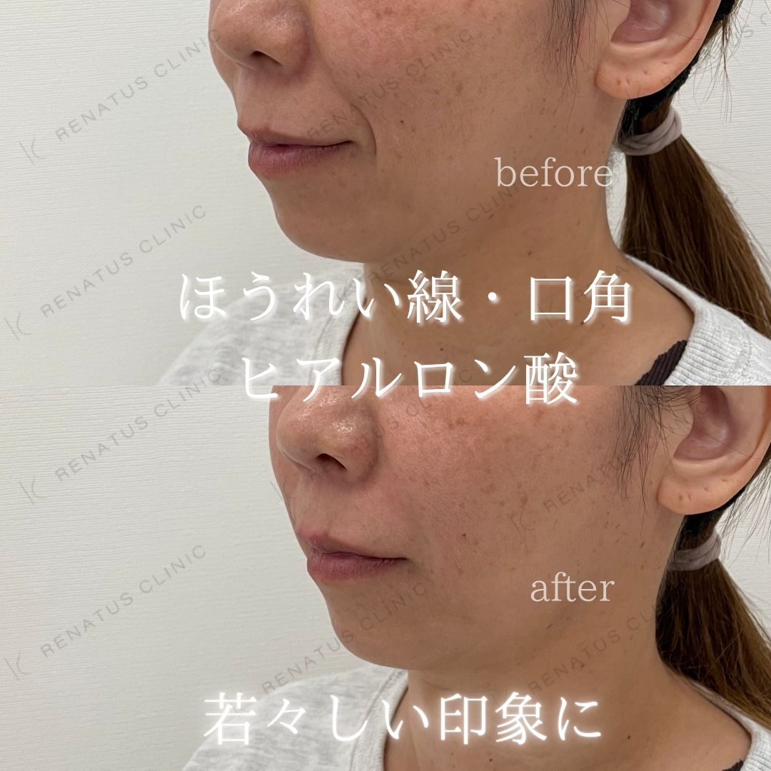 ヒアルロン酸仙台ほうれい線上手い ヒアルロン酸仙台ほうれい線上手い