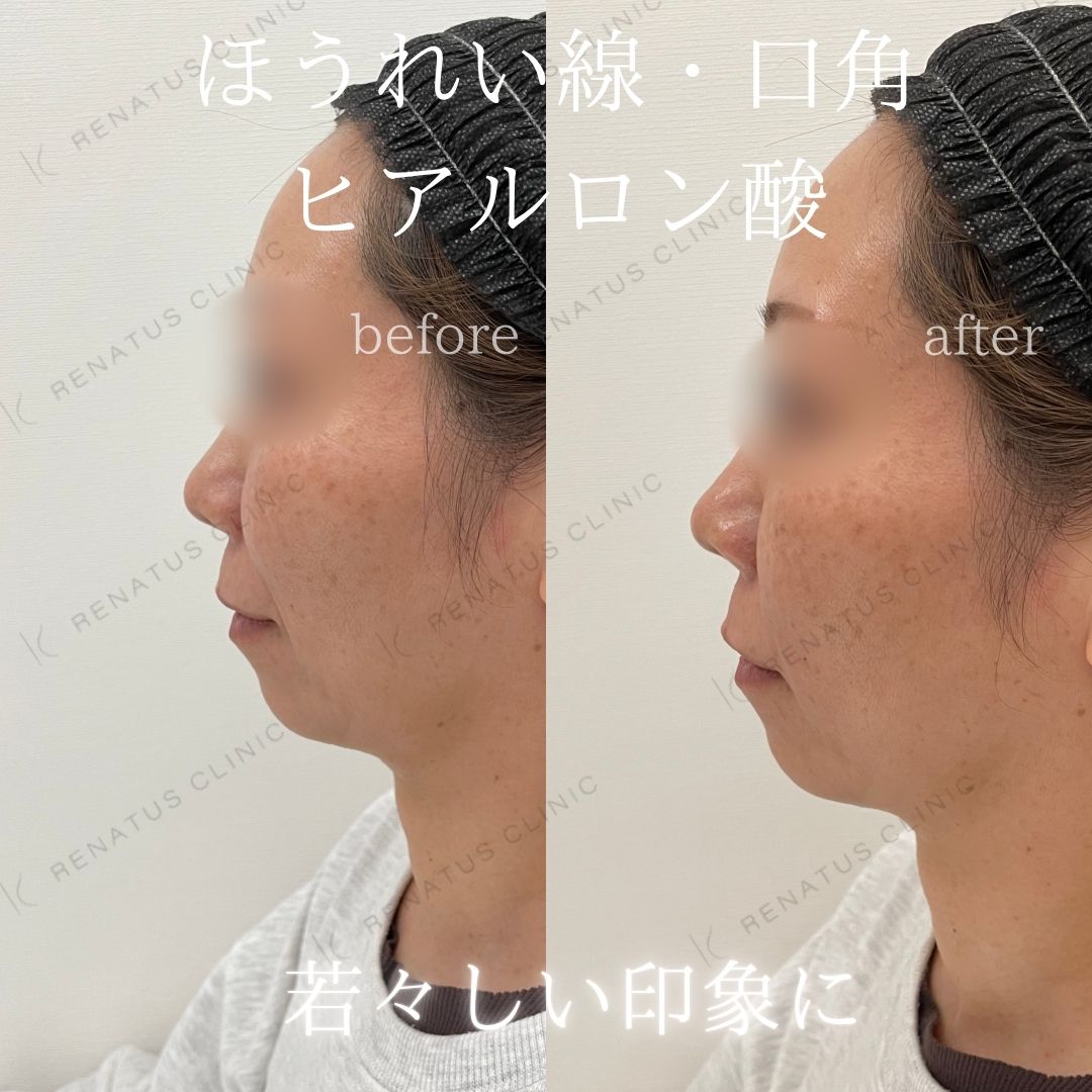 ヒアルロン酸仙台ほうれい線上手い ヒアルロン酸仙台ほうれい線上手い