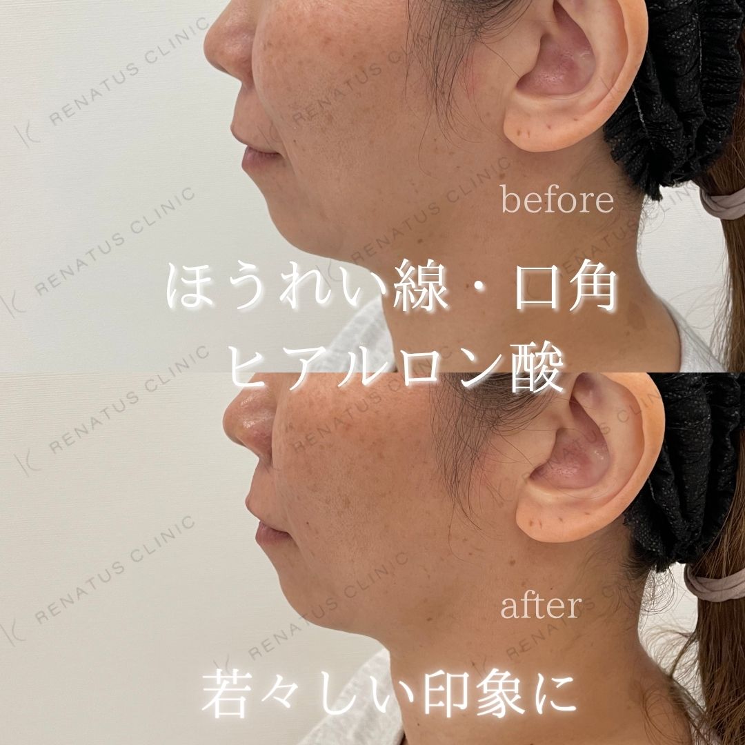 ヒアルロン酸仙台ほうれい線上手い ヒアルロン酸仙台ほうれい線上手い