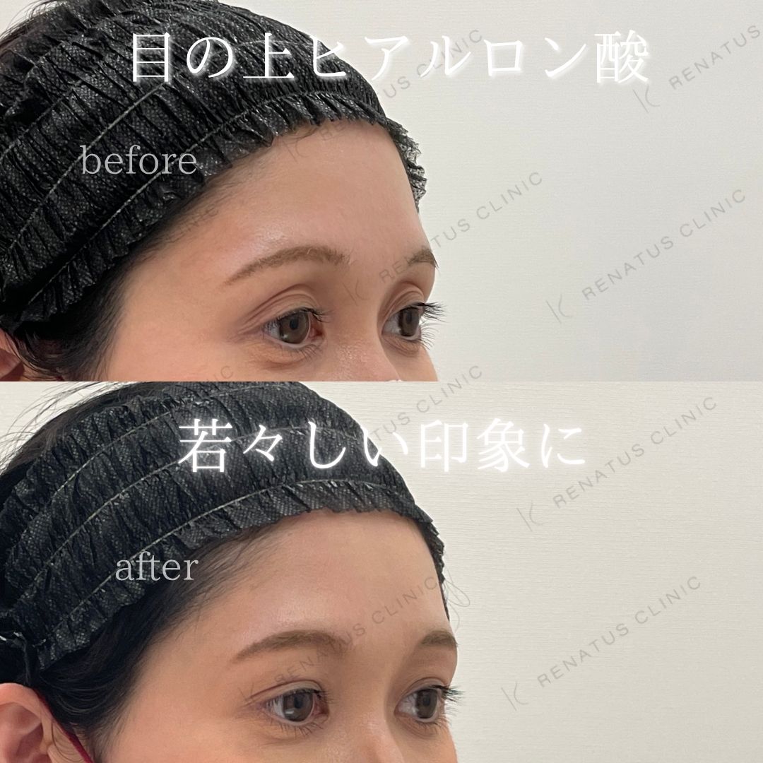 目の上ボルベラヒアルロン酸 目の上ボルベラヒアルロン酸