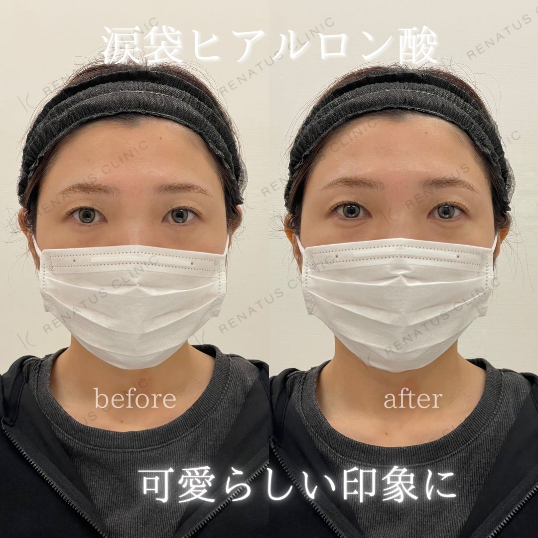 仙台涙袋ヒアルロン酸上手い先生 仙台涙袋ヒアルロン酸上手い先生