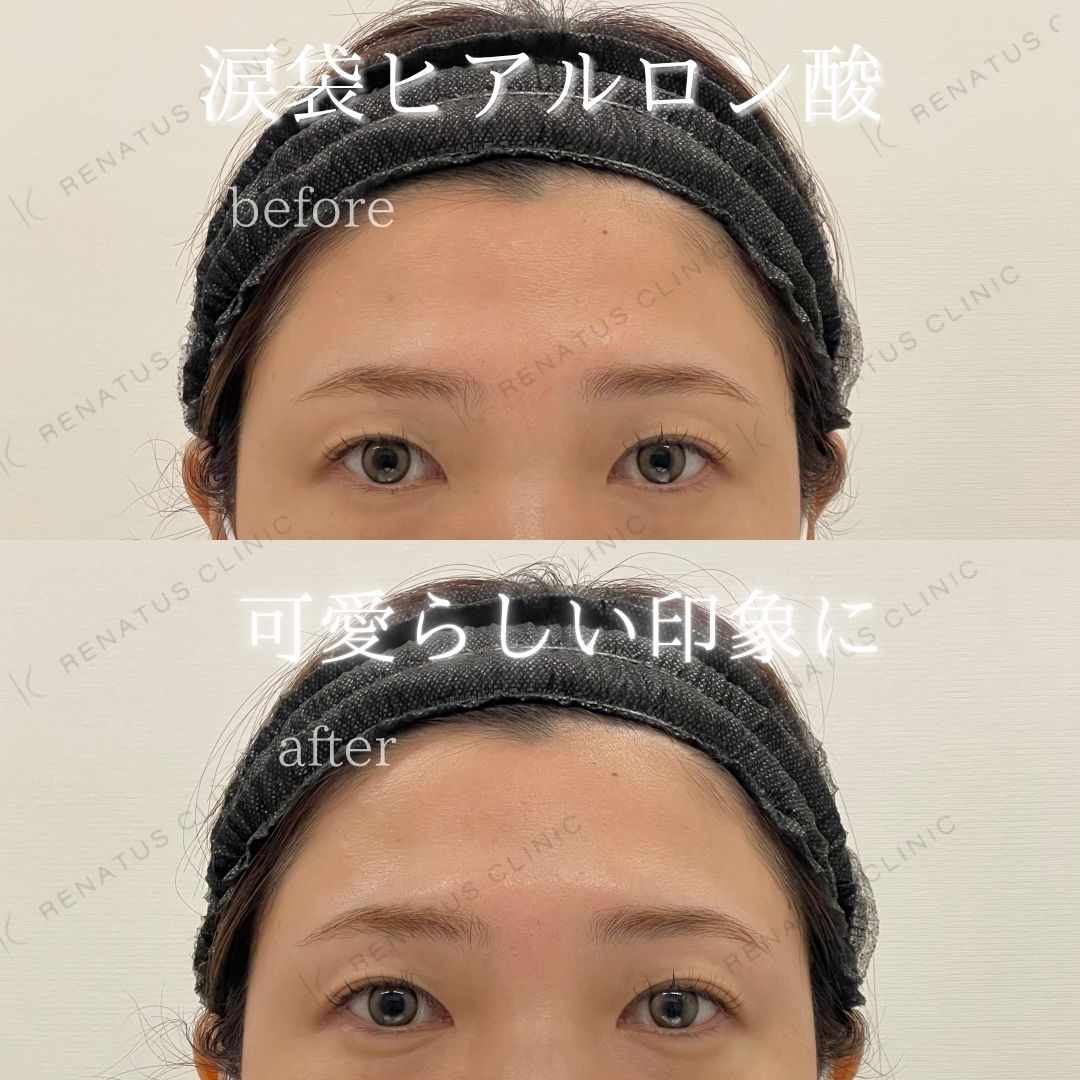 仙台涙袋ヒアルロン酸上手い先生 仙台涙袋ヒアルロン酸上手い先生