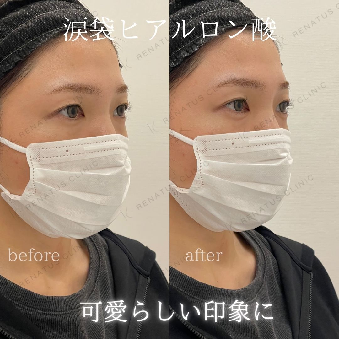 仙台涙袋ヒアルロン酸上手い先生 仙台涙袋ヒアルロン酸上手い先生