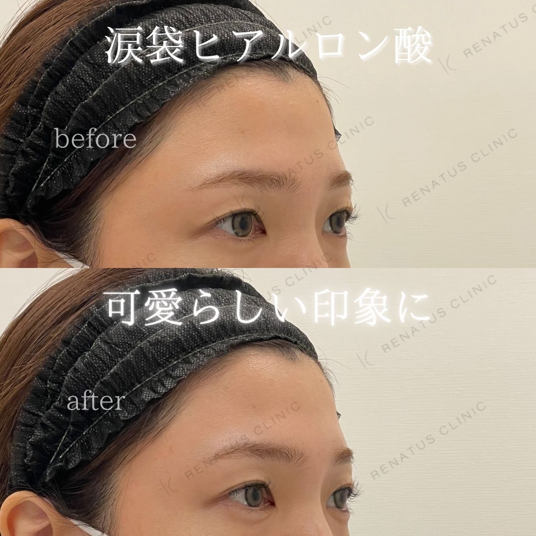 仙台涙袋ヒアルロン酸上手い先生 仙台涙袋ヒアルロン酸上手い先生