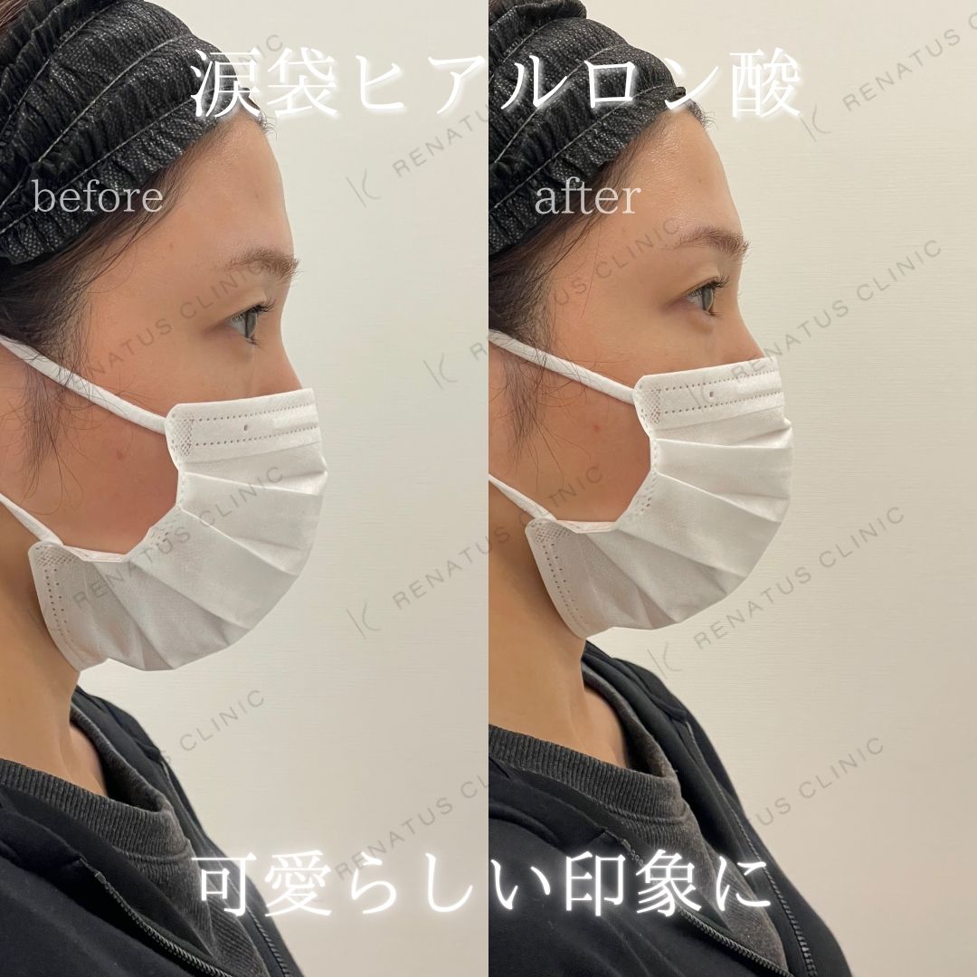 仙台涙袋ヒアルロン酸上手い先生 仙台涙袋ヒアルロン酸上手い先生