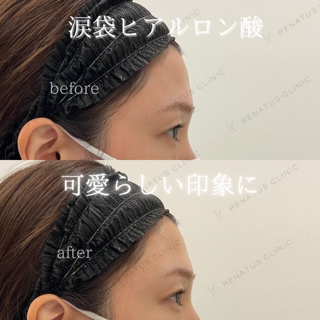 仙台涙袋ヒアルロン酸上手い先生 仙台涙袋ヒアルロン酸上手い先生