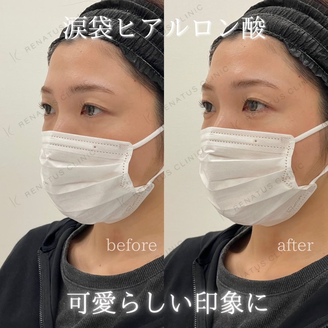 仙台涙袋ヒアルロン酸上手い先生 仙台涙袋ヒアルロン酸上手い先生