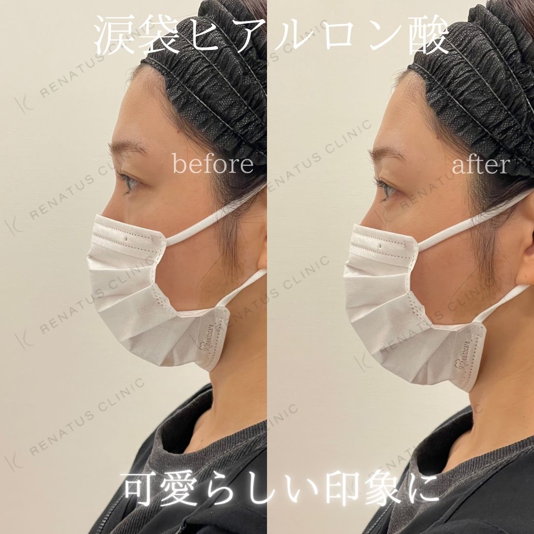 仙台涙袋ヒアルロン酸上手い先生 仙台涙袋ヒアルロン酸上手い先生