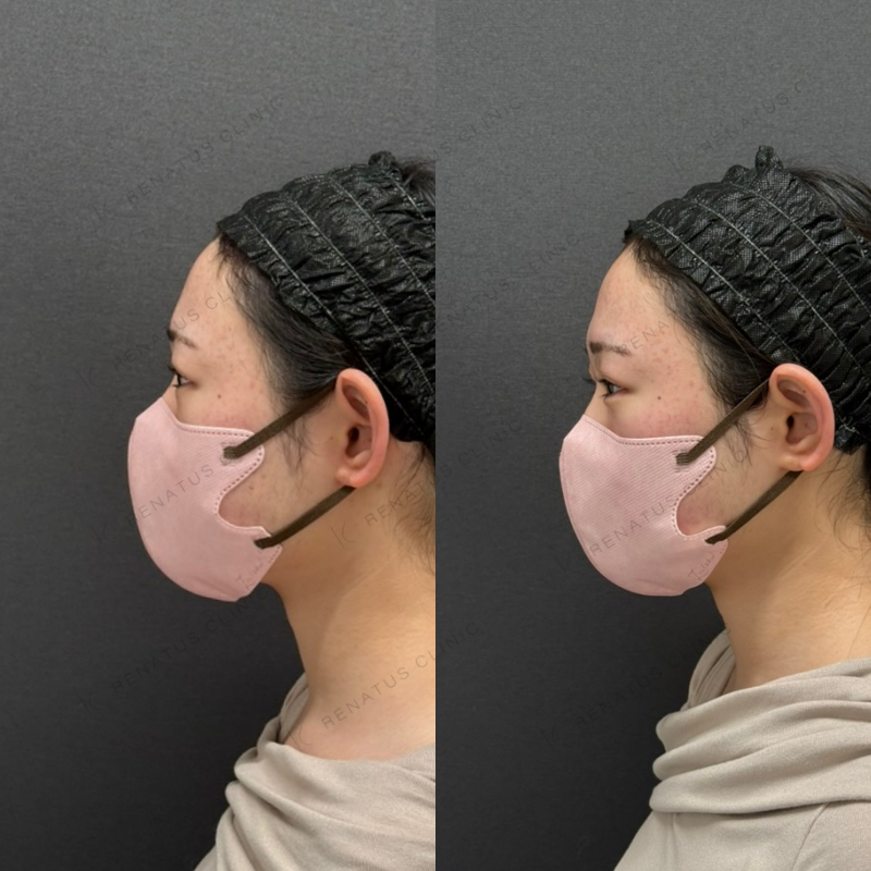 福岡_1041_辻橋Dr_涙袋_ボルベラ_女性_20_左-