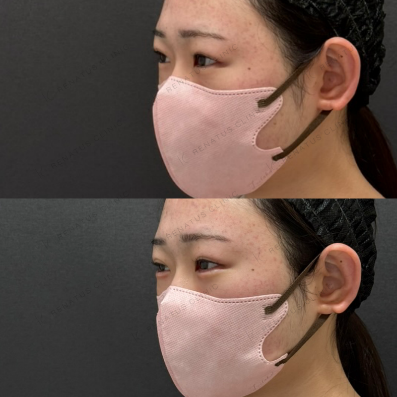 福岡_1041_辻橋Dr_涙袋_ボルベラ_女性_20_斜め左