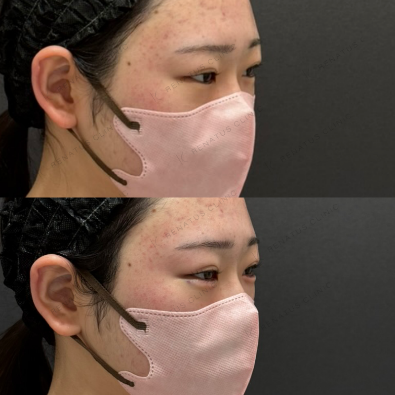 福岡_1041_辻橋Dr_涙袋_ボルベラ_女性_20_斜め右
