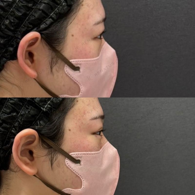 福岡_1041_辻橋Dr_涙袋_ボルベラ_女性_20_右