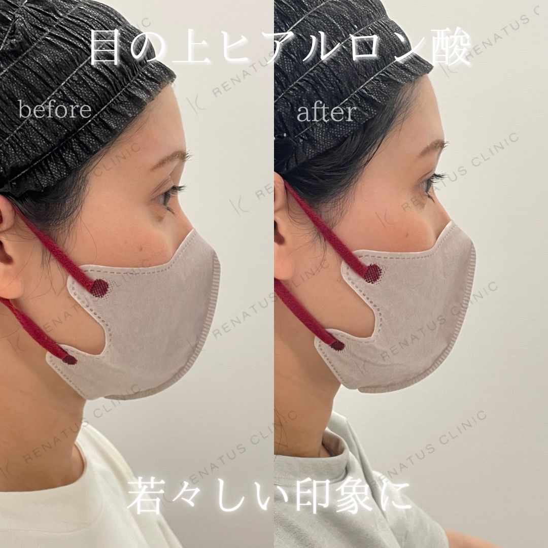 目の上ボルベラヒアルロン酸 目の上ボルベラヒアルロン酸