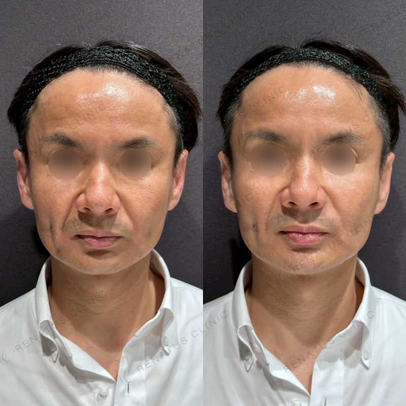 リフトアップヒアルロン酸ボリューマ症例写真 リフトアップヒアルロン酸ボリューマ症例写真