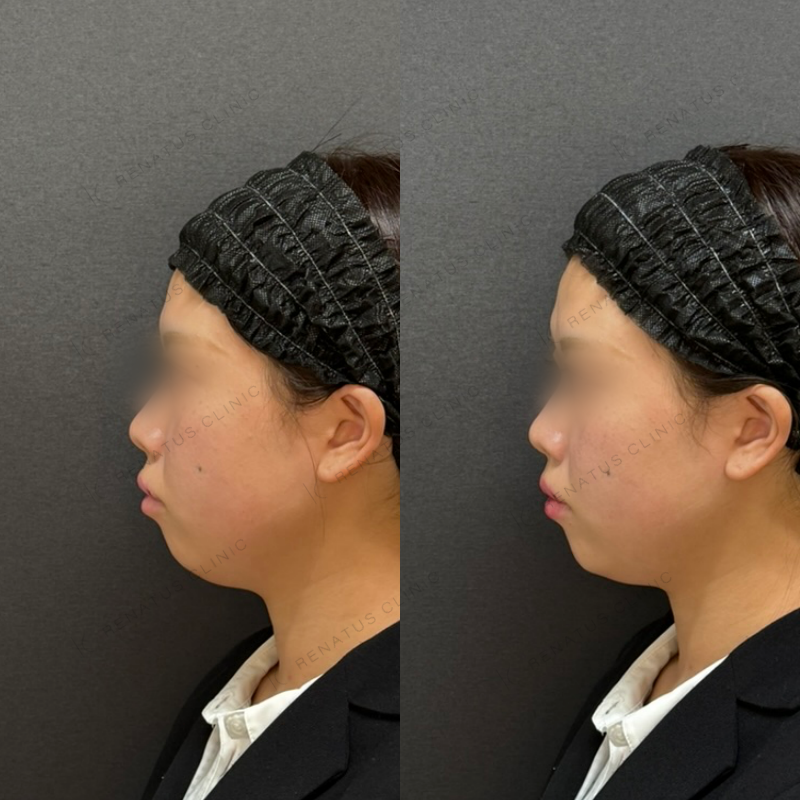 福岡_1023_辻橋Dr_顎_ヒアルロン酸_女性_23_左- 顎ヒアルロン酸症例写真