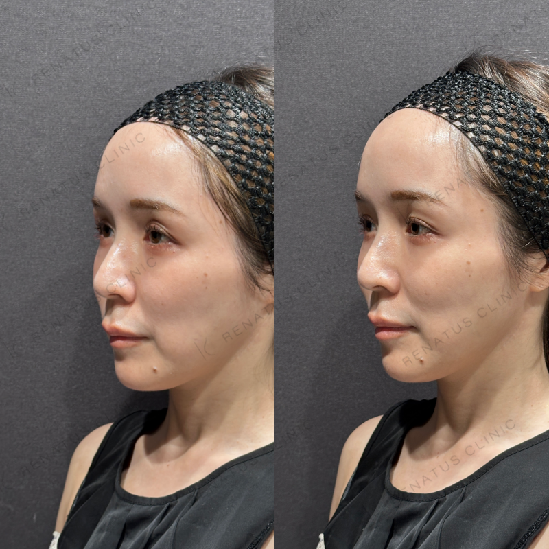 目の上ヒアルロン酸ボルベラ症例写真 目の上ヒアルロン酸ボルベラ症例写真