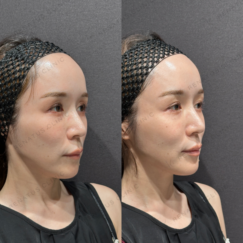 目の上ヒアルロン酸ボルベラ症例写真