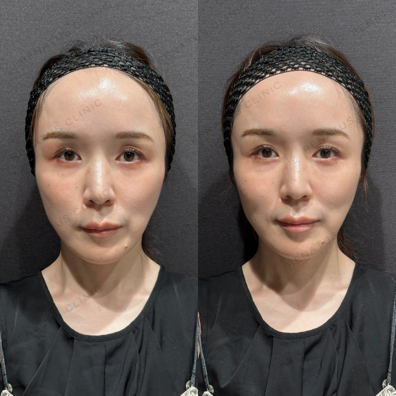 目の上ヒアルロン酸ボルベラ症例写真 目の上ヒアルロン酸ボルベラ症例写真
