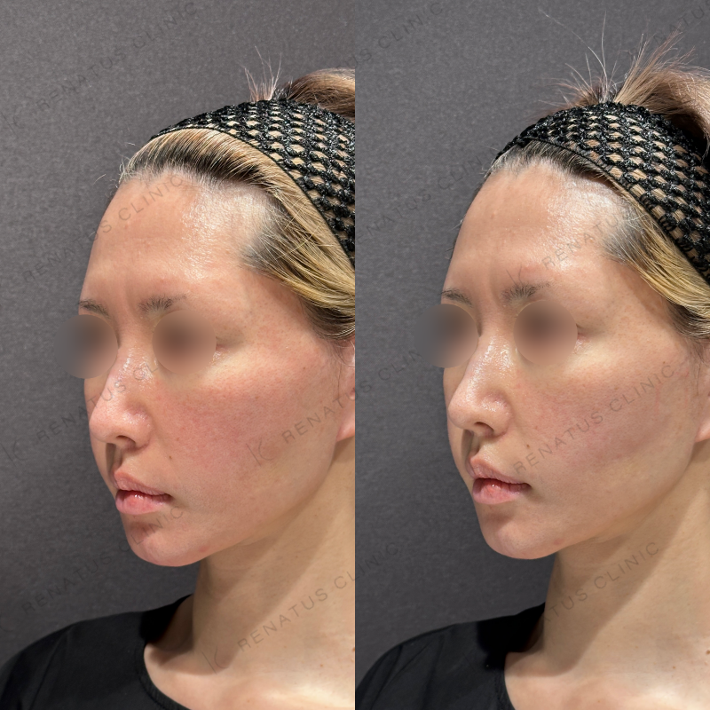 頬こけヒアルロン酸ボリフト症例写真 頬こけヒアルロン酸ボリフト症例写真