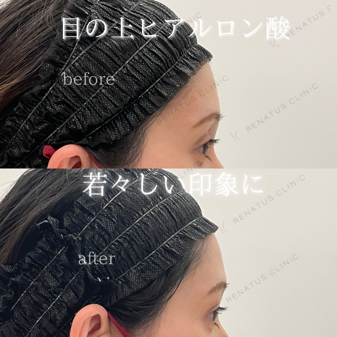 目の上ボルベラヒアルロン酸 目の上ボルベラヒアルロン酸