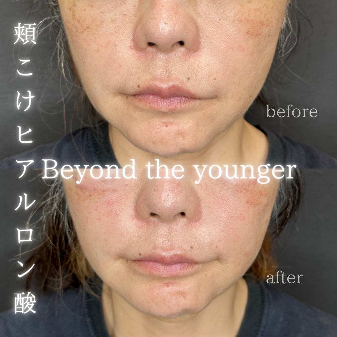 頬ヒアルロン酸ボリューマ症例写真 頬ヒアルロン酸ボリューマ症例写真
