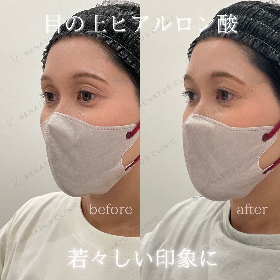 目の上ボルベラヒアルロン酸 目の上ボルベラヒアルロン酸