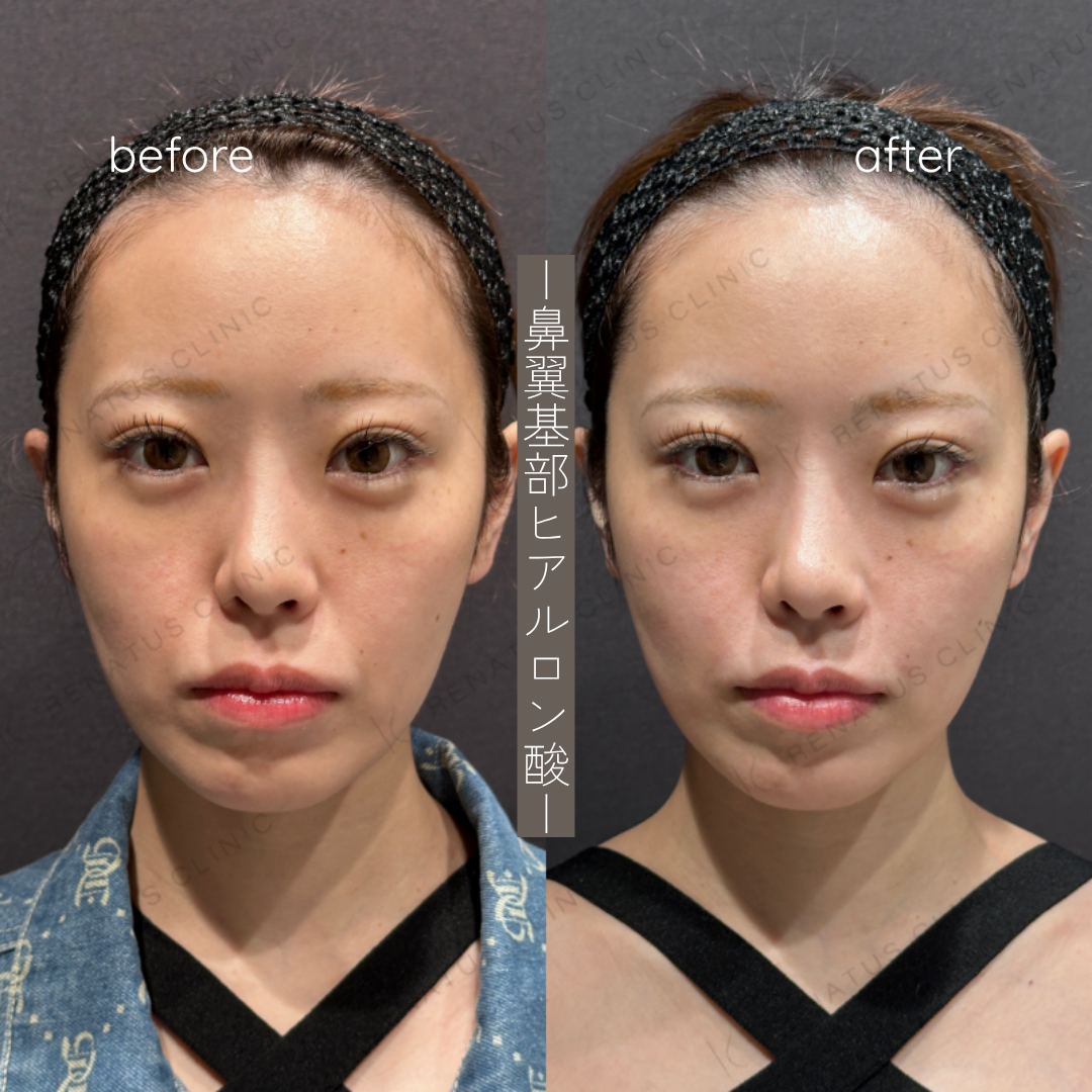 鼻翼基部ヒアルロン酸症例写真 鼻翼基部ヒアルロン酸症例写真