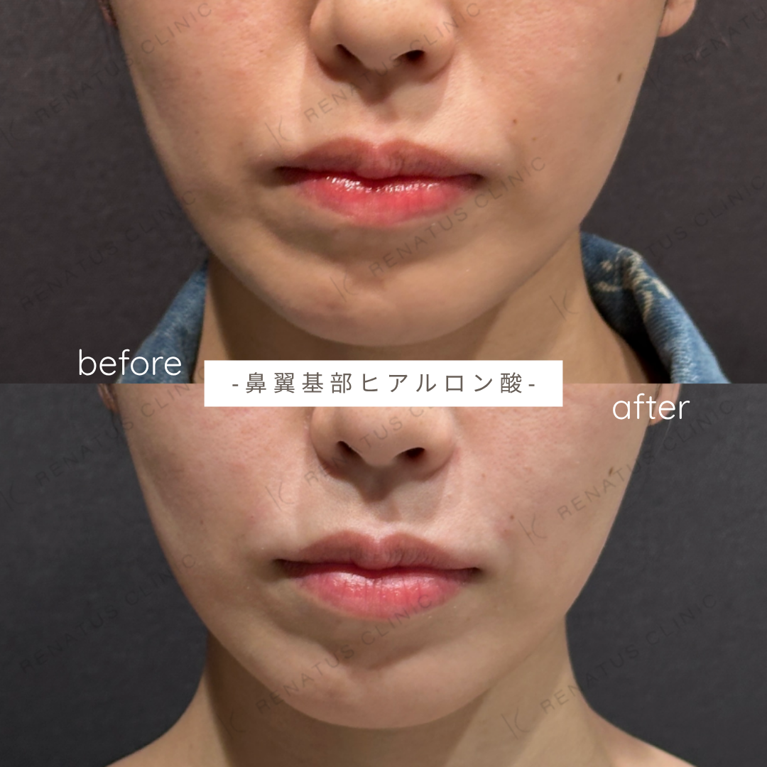 鼻翼基部ヒアルロン酸症例写真 鼻翼基部ヒアルロン酸症例写真