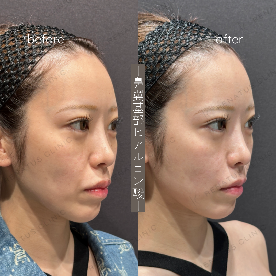 鼻翼基部ヒアルロン酸症例写真 鼻翼基部ヒアルロン酸症例写真