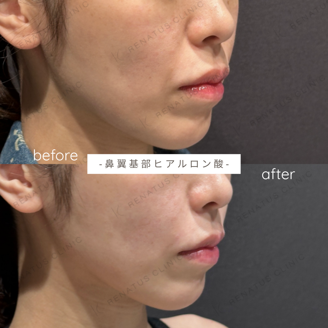 鼻翼基部ヒアルロン酸症例写真 鼻翼基部ヒアルロン酸症例写真