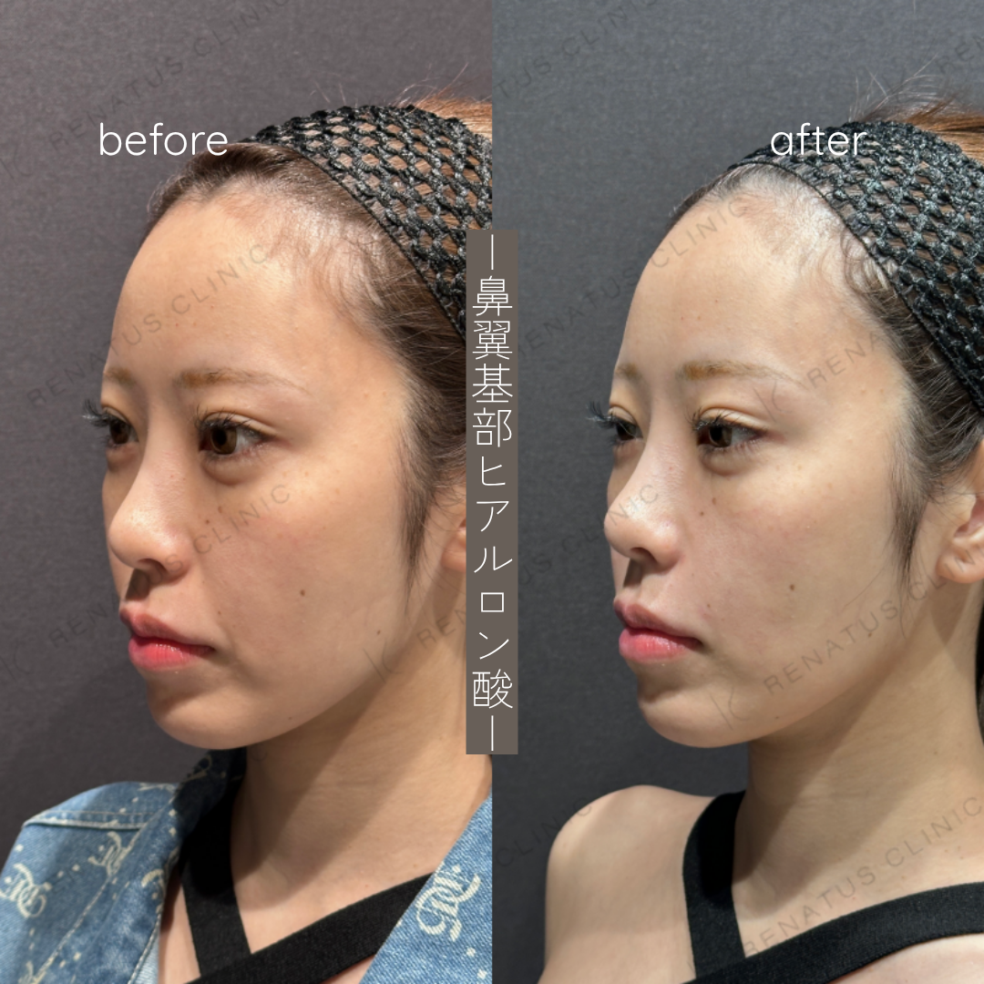 鼻翼基部ヒアルロン酸症例写真 鼻翼基部ヒアルロン酸症例写真