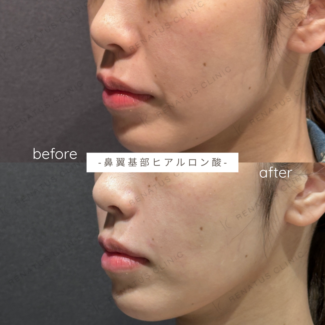 鼻翼基部ヒアルロン酸症例写真 鼻翼基部ヒアルロン酸症例写真