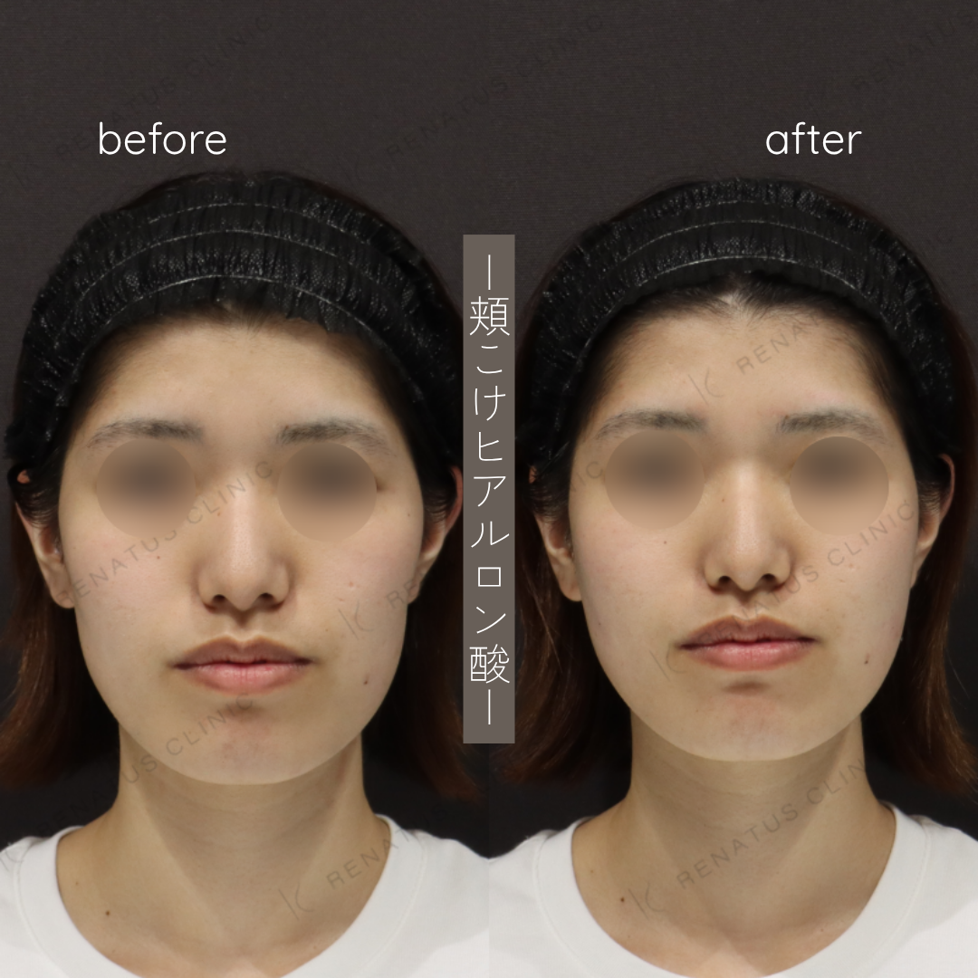 頬コケヒアルロン酸ボリフト症例写真 頬コケヒアルロン酸ボリフト症例写真