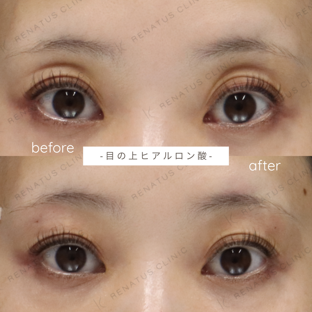 目の上・上まぶたのくぼみへのヒアルロン酸注入症例写真 目の上・上まぶたのくぼみへのヒアルロン酸注入症例写真