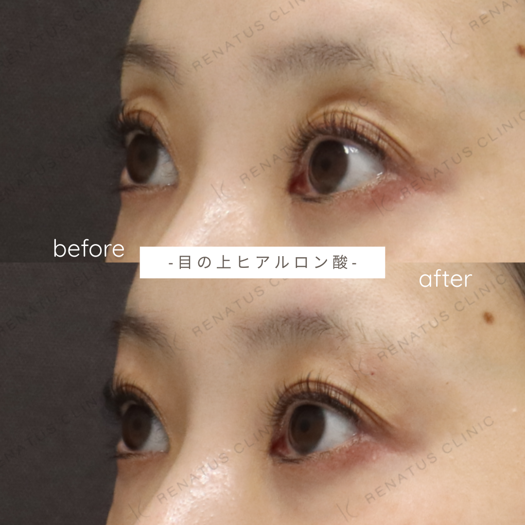目の上・上まぶたのくぼみへのヒアルロン酸注入症例写真 目の上・上まぶたのくぼみへのヒアルロン酸注入症例写真
