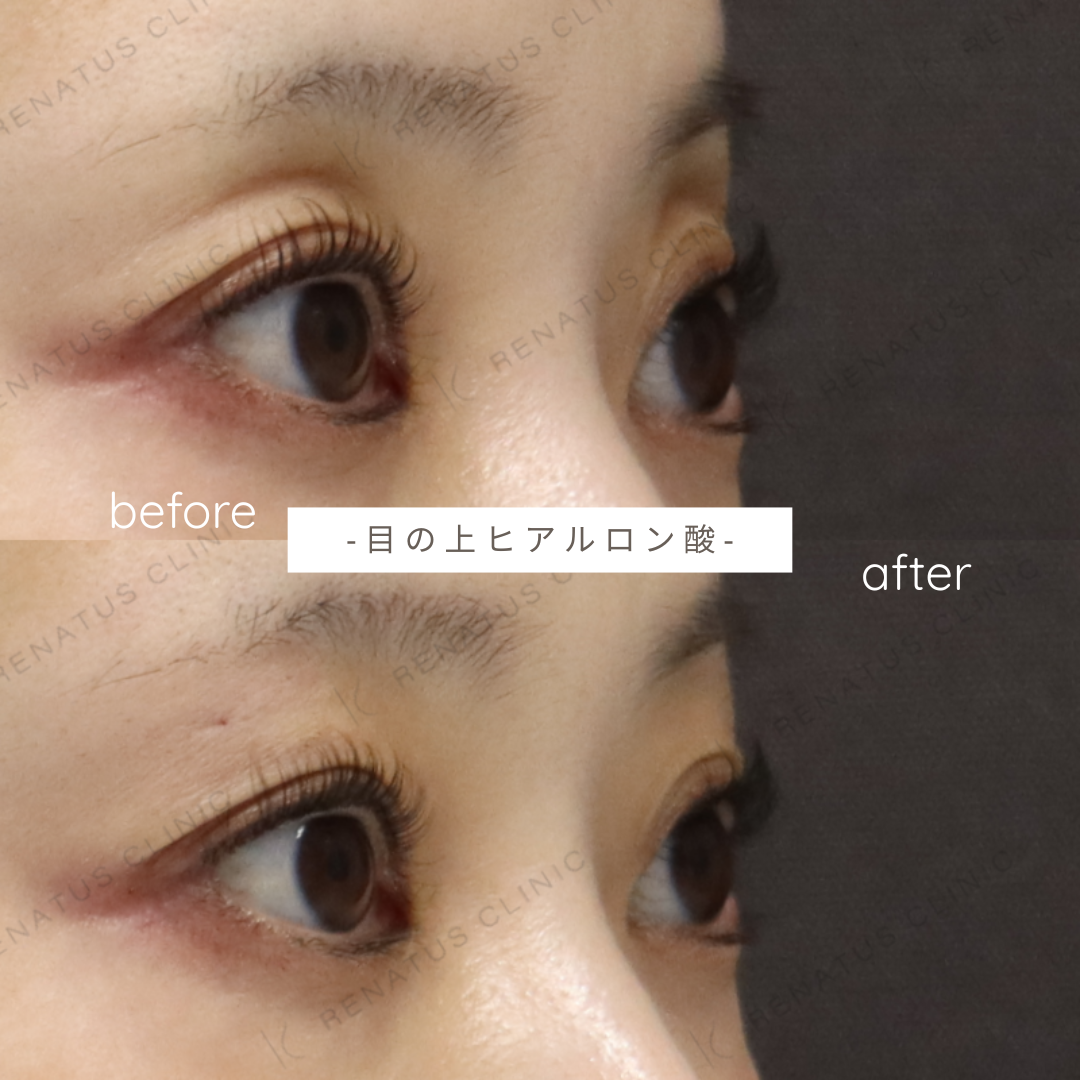 目の上・上まぶたのくぼみへのヒアルロン酸注入症例写真 目の上・上まぶたのくぼみへのヒアルロン酸注入症例写真