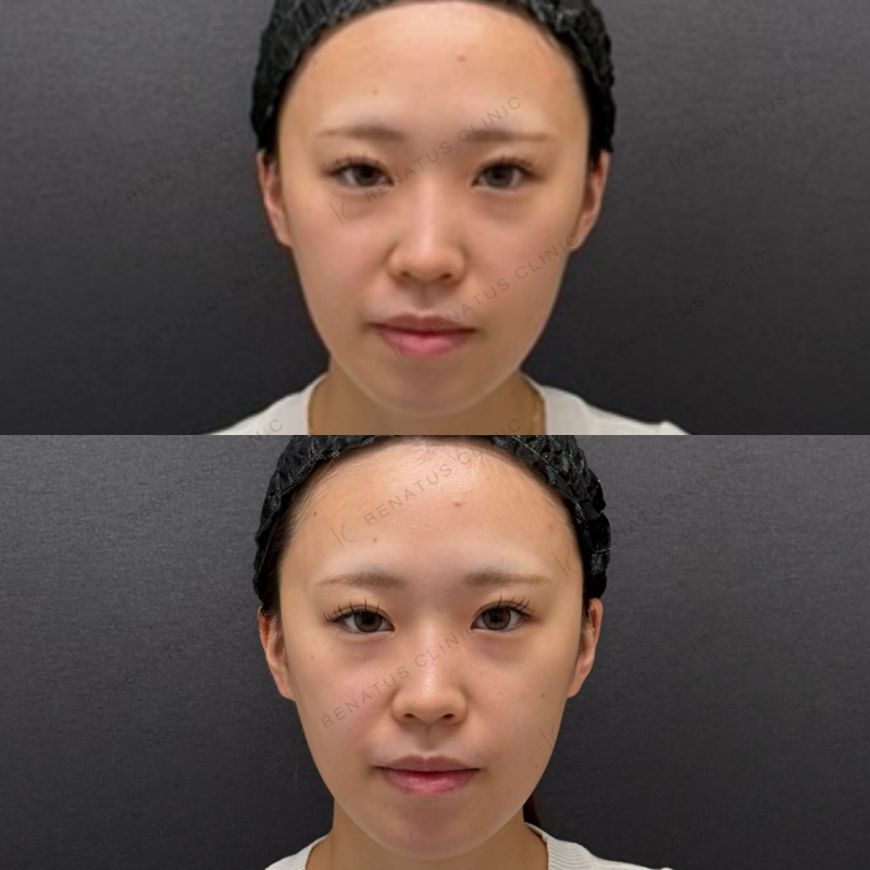 福岡_917_副田Dr_鼻翼基部_ヒアルロン酸_女性_21_正面 鼻翼基部ヒアルロン酸症例写真