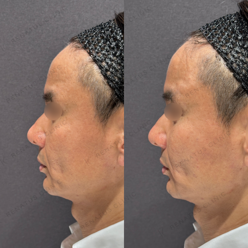 リフトアップヒアルロン酸ボリューマ症例写真 リフトアップヒアルロン酸ボリューマ症例写真