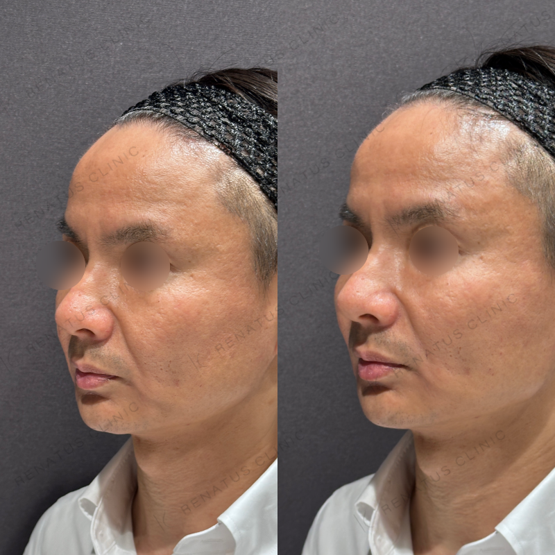 リフトアップヒアルロン酸ボリューマ症例写真 リフトアップヒアルロン酸ボリューマ症例写真