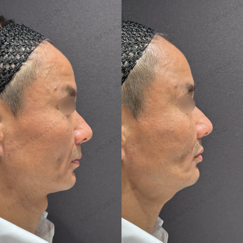 リフトアップヒアルロン酸ボリューマ症例写真 リフトアップヒアルロン酸ボリューマ症例写真