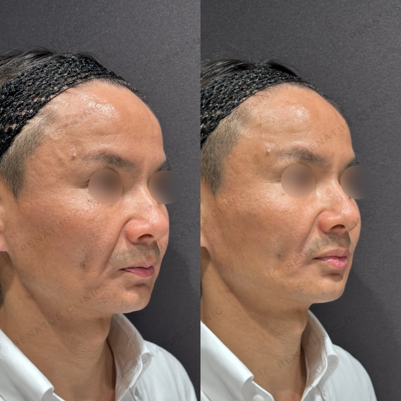 リフトアップヒアルロン酸ボリューマ症例写真 リフトアップヒアルロン酸ボリューマ症例写真