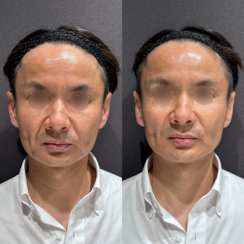 リフトアップヒアルロン酸ボリューマ症例写真 リフトアップヒアルロン酸ボリューマ症例写真