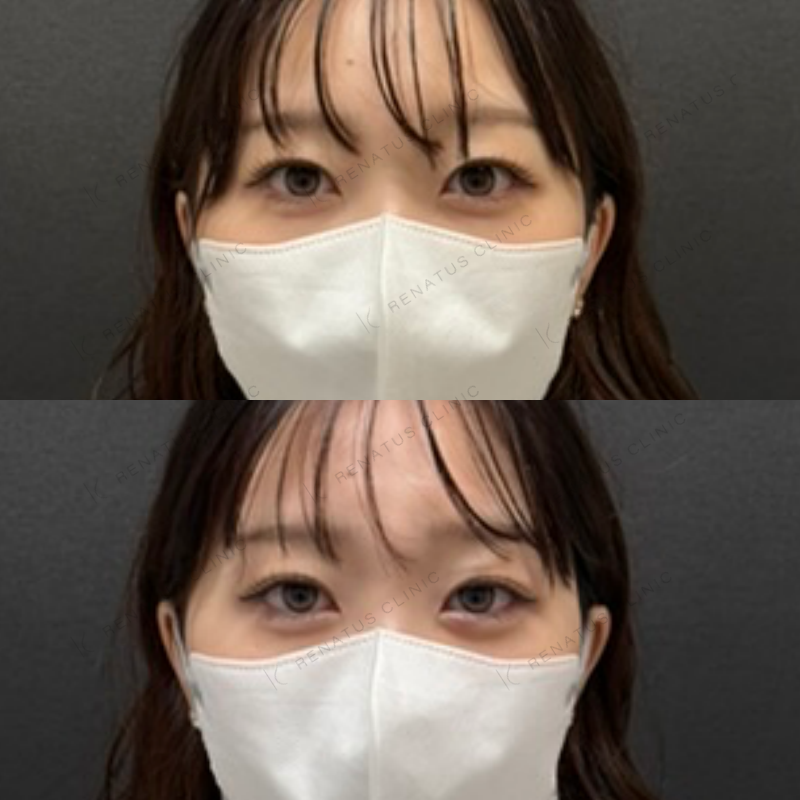 福岡_914_副田Dr_涙袋_ヒアルロン酸_女性_23_正面 涙袋ヒアルロン酸症例写真